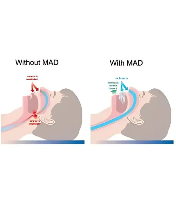 Somnofit Anti Snoring Device